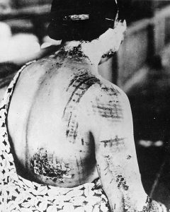 A black and white photograph of blotchy petechiae on a woman's skin