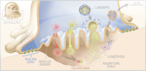 A medical illustration by Richard Howdy Jr. depicting osteoclasts