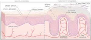 A medical illustration comparing normal epidermis to psoriasis pathogenesis