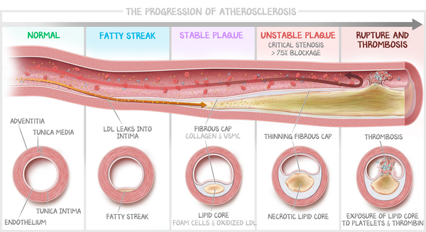 Nutrition Fig 6.2 Progression of Atherosclerosis - LC-601x327-87d81f9