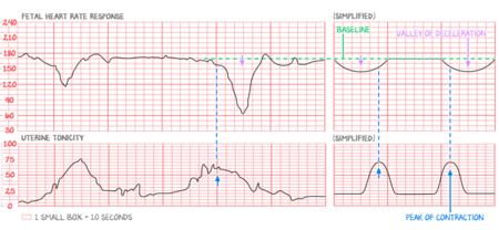 Obstetrics fig n.8 fetal heart tracings examples of variable decels-AE-599x278-04d517b