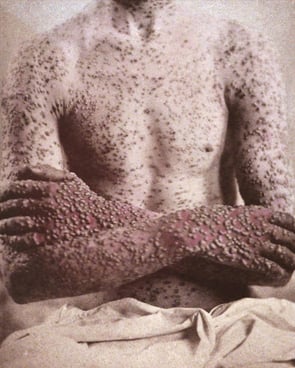 c. Smallpox